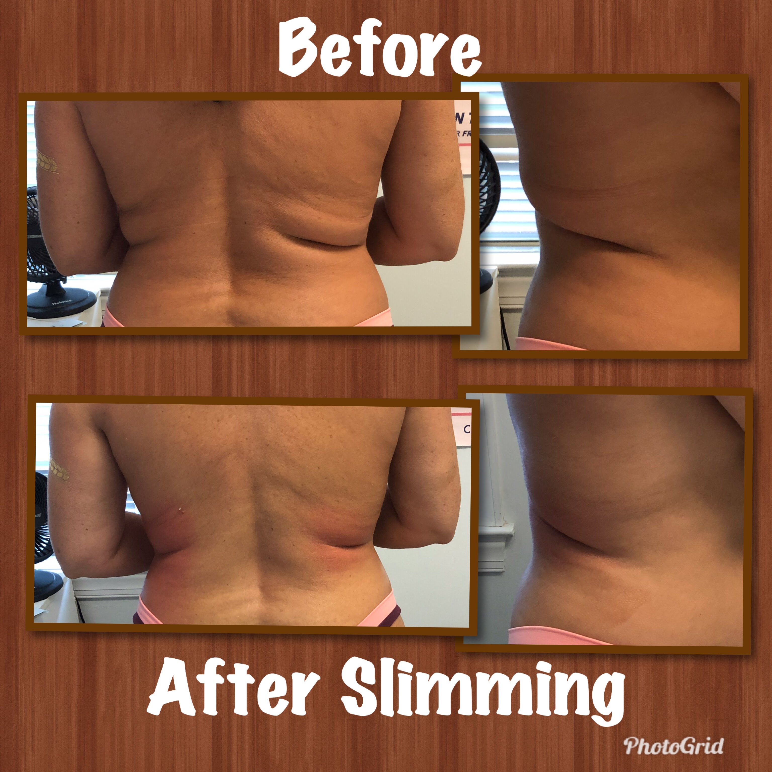 Before and after Cryoskin treatment - back