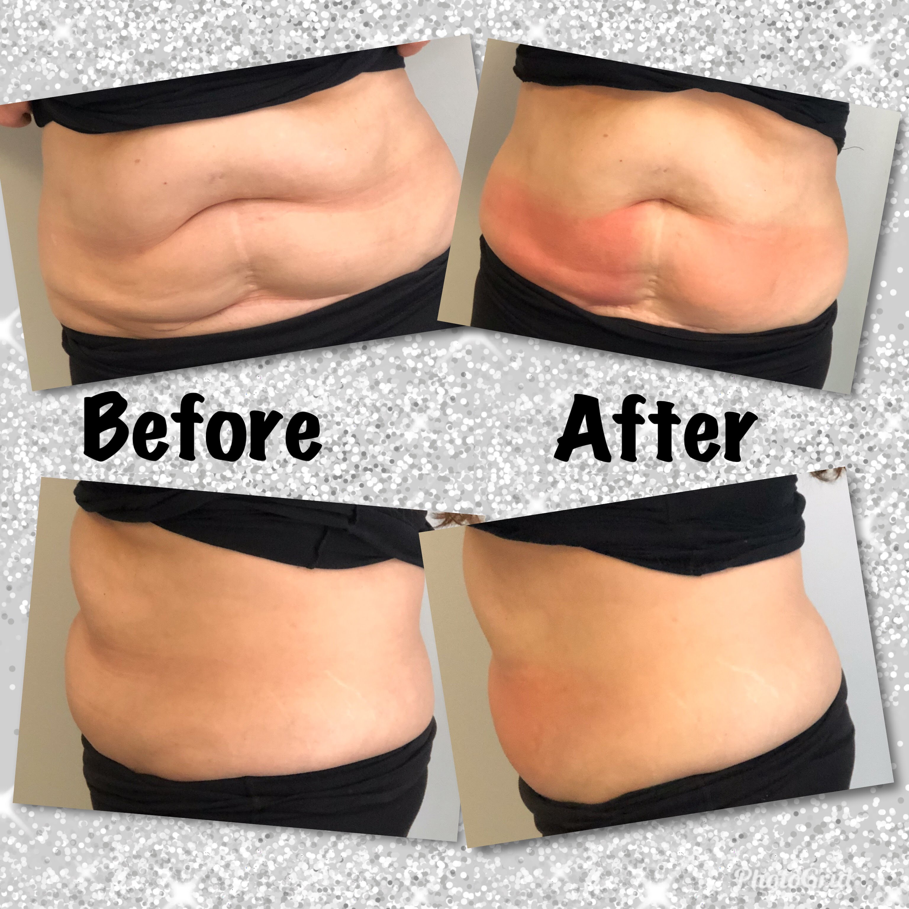 Before and after Cryoskin treatment - stomach