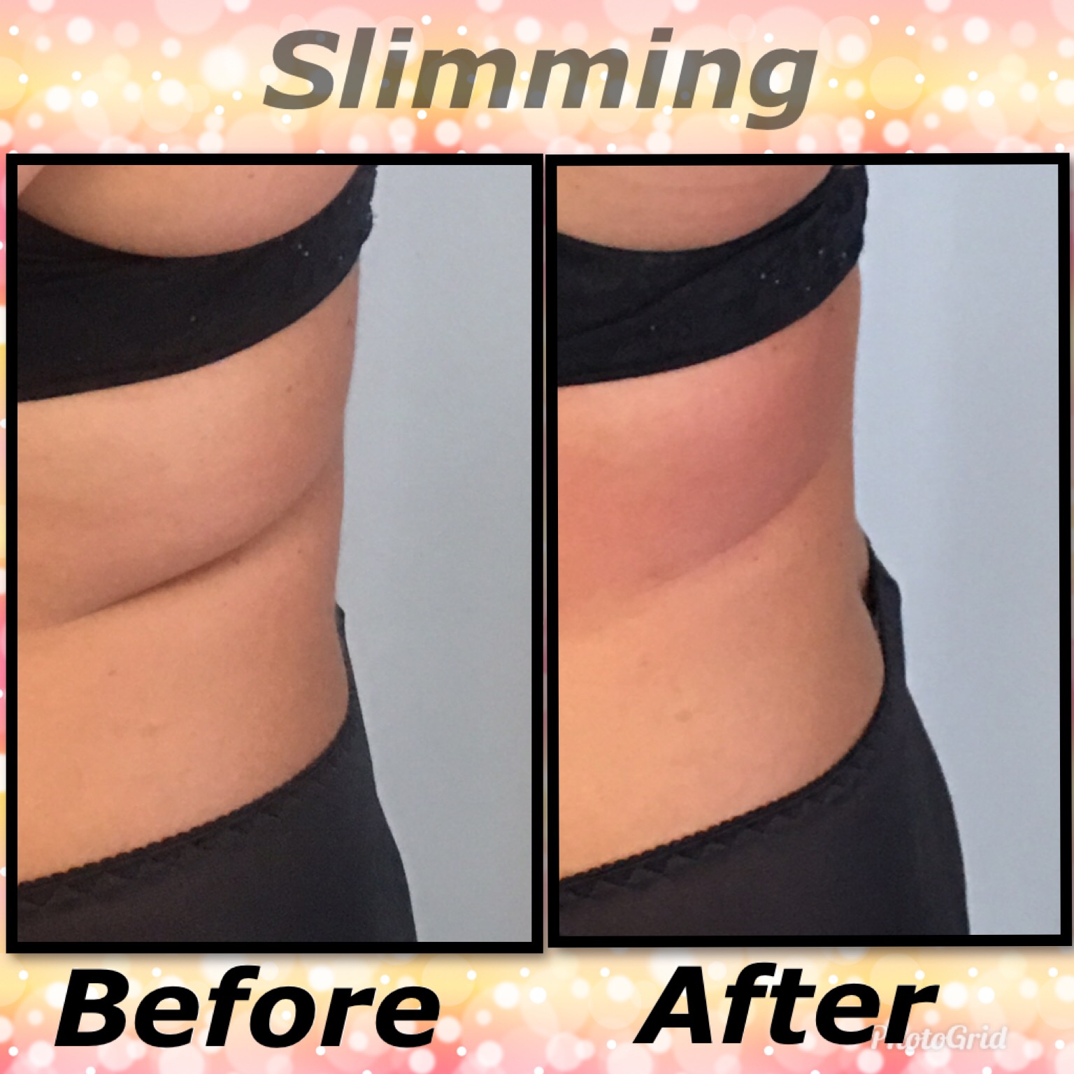 Before and after Cryoskin slimming - waist
