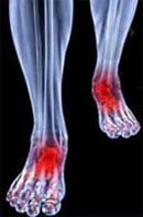 Diabetic Neuropathy